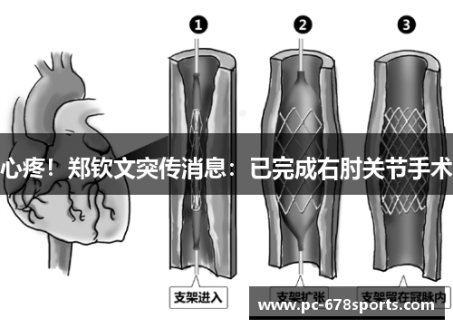 心疼！郑钦文突传消息：已完成右肘关节手术